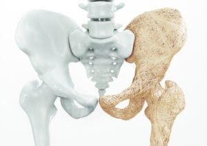 Robert Franz Osteoporose