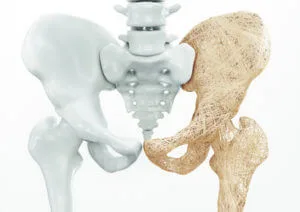 Robert Franz Osteoporose